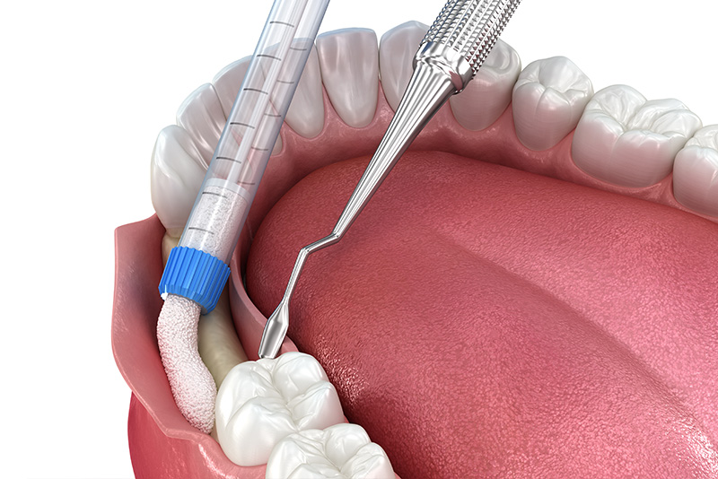 An image of a dental implant procedure in progress, with a drill inserted into the gum and a blue cap on a screw.