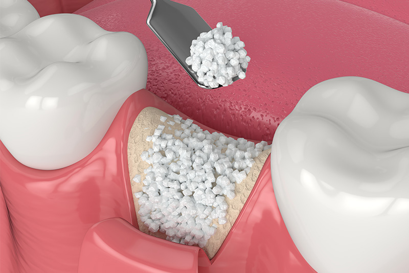 An illustration showing a close-up view of a dental implant procedure, with a surgical drill in action and a small pile of white particles, possibly bone fragments or implant material.