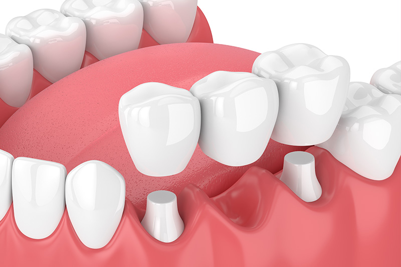 An illustration of a detailed, 3D model of an open human mouth with white teeth and pink gums.