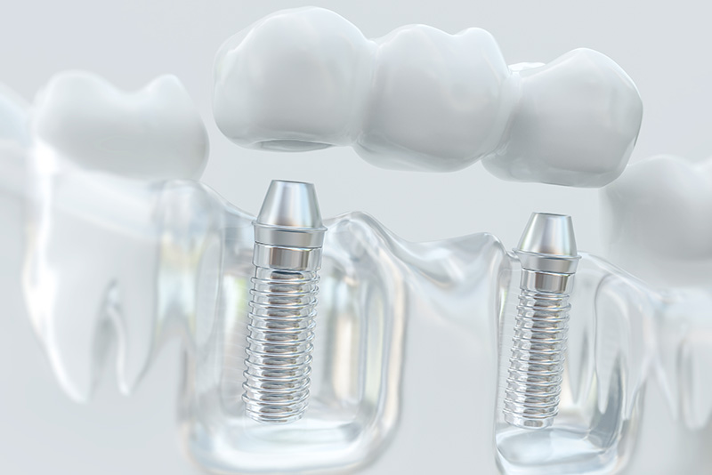A clear, 3D rendering of a dental implant with a screw-like attachment.