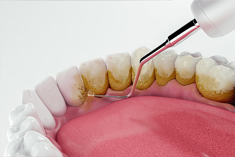 An illustration of a dental procedure in progress, with a focus on a dental drill and a close-up view of the tooth being treated.