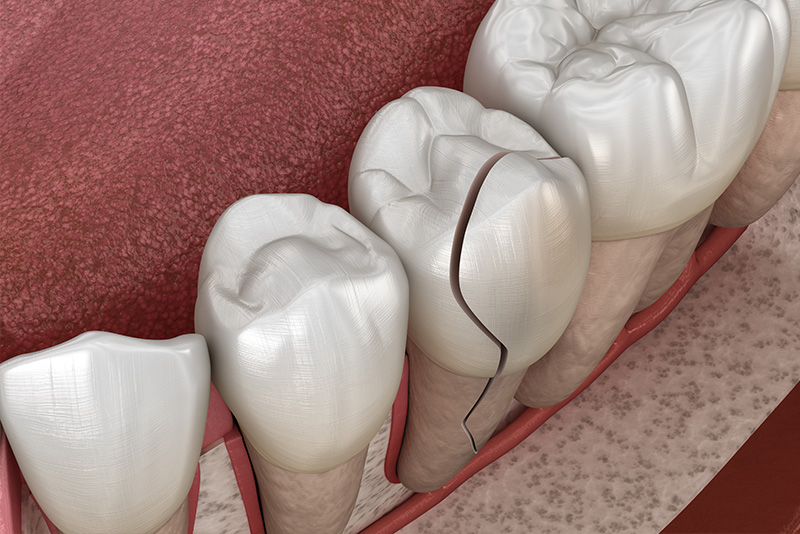 The image displays a detailed 3D rendering of human teeth, showing the structure and components of a dental implant inside an oral cavity with visible gum tissue.