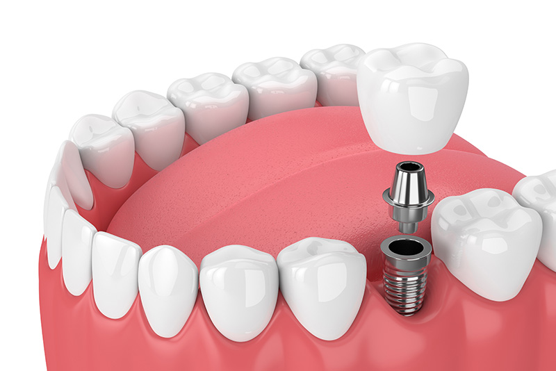 An illustration of a dental model with artificial teeth, displaying a tooth drill and a small metal screw in the center, set against a white background.