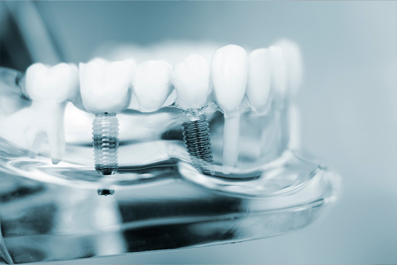 An image of a transparent dental model with visible screws and a clear plastic base, showcasing a set of upper teeth.
