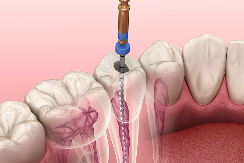 An illustration of a dental procedure, showing a drill in operation near a tooth with visible pulp, surrounded by pink gum tissue and dental instruments.