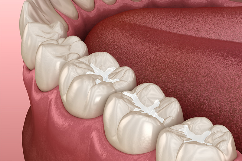 A digital illustration of an open human mouth with teeth and gums, showing a partial view of dental implants.