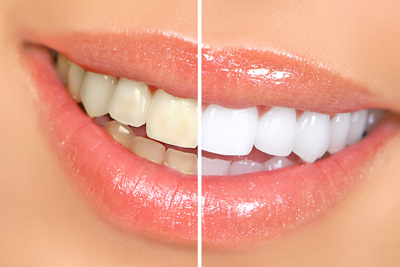 The image shows a side-by-side comparison of a person s teeth before and after dental treatment, highlighting the transformation achieved through teeth whitening.