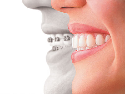 The image is a promotional graphic for dental implants, featuring a smiling woman with an overlay of a man s face in profile, suggesting the transformation from tooth loss to restored oral health.