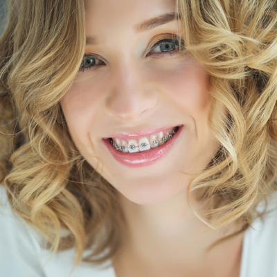 The image shows a woman with braces smiling at the camera, wearing a white top and having blonde hair.